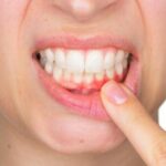 Опасный пародонтит: стоматолог назвала 7 факторов риска для зубов