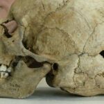 Тайна древних хирургов: зачем наши предки сверлили черепа наживую