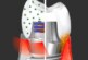 Новый зубной имплантат может лечить десны