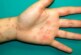 Кожная сыпь у ребенка: коронавирус или просто аллергия?